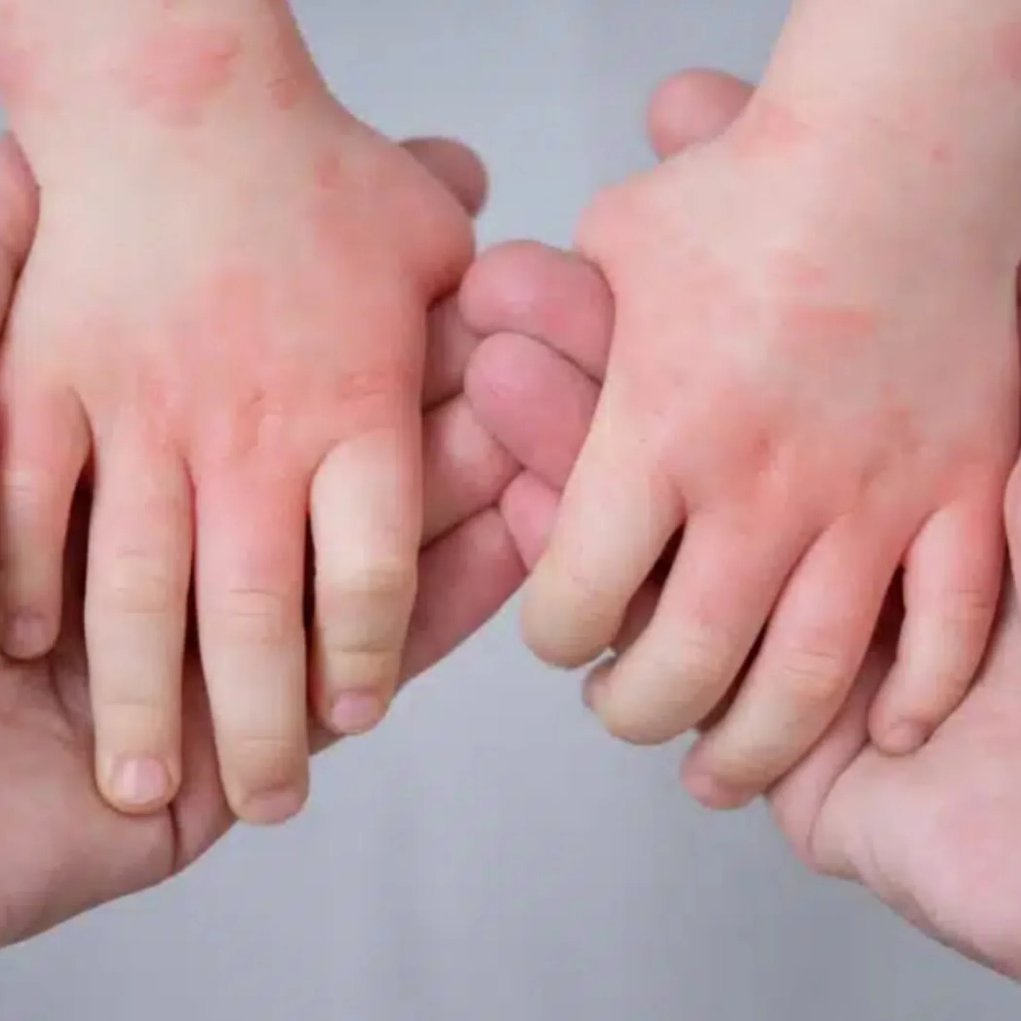 children with dry, irritated skin